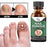 Fast Nail Fungal Treatments Nail Repair Essences Serum Care Treatments Foot Nail Fungus Removal Gel