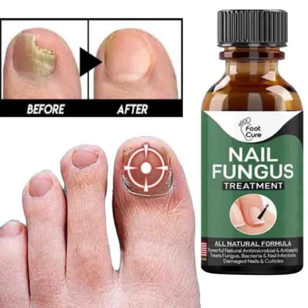 Fast Nail Fungal Treatments Nail Repair Essences Serum Care Treatments Foot Nail Fungus Removal Gel - CHAUDHARY BRAND STORE